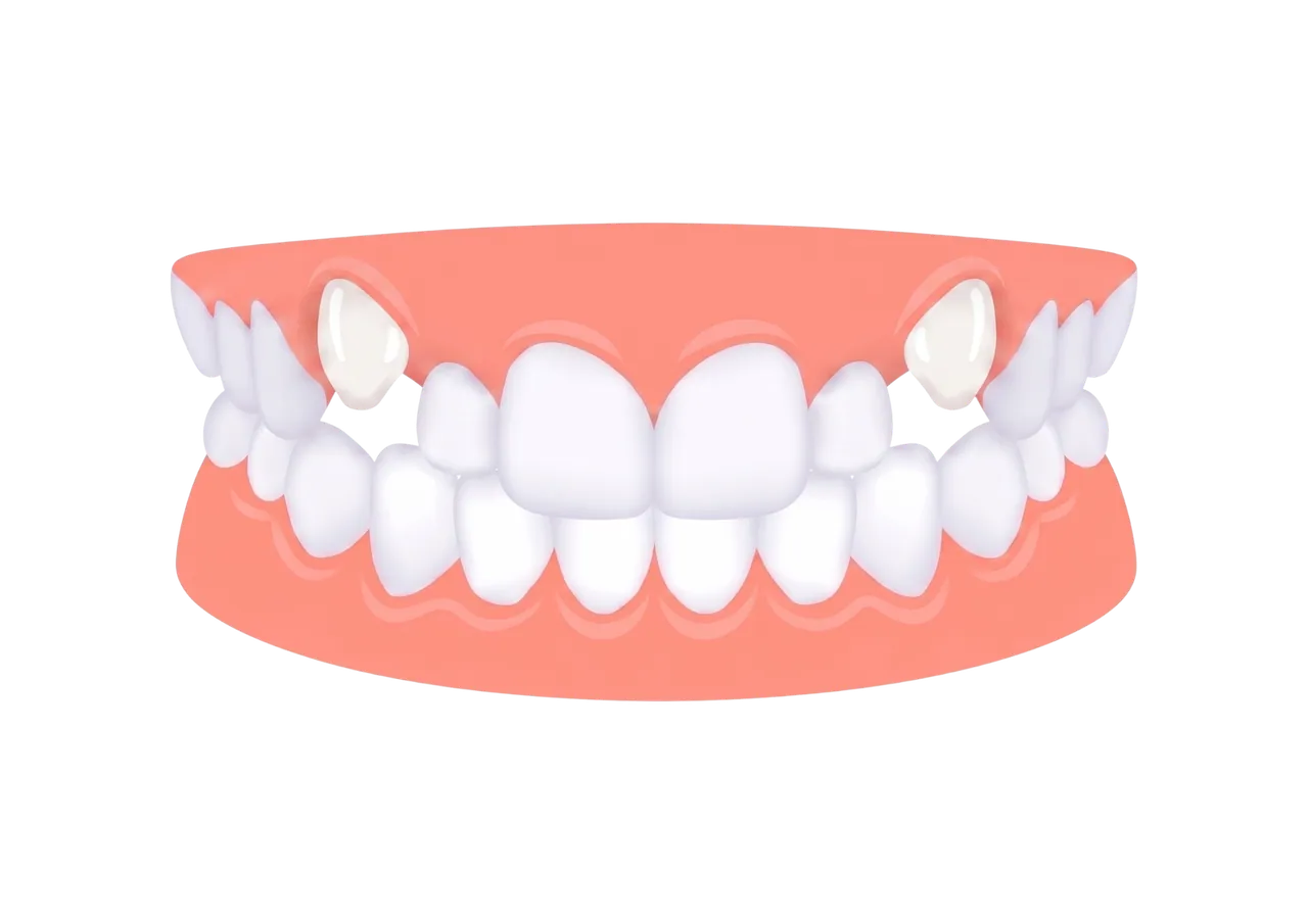 Displaced teeth