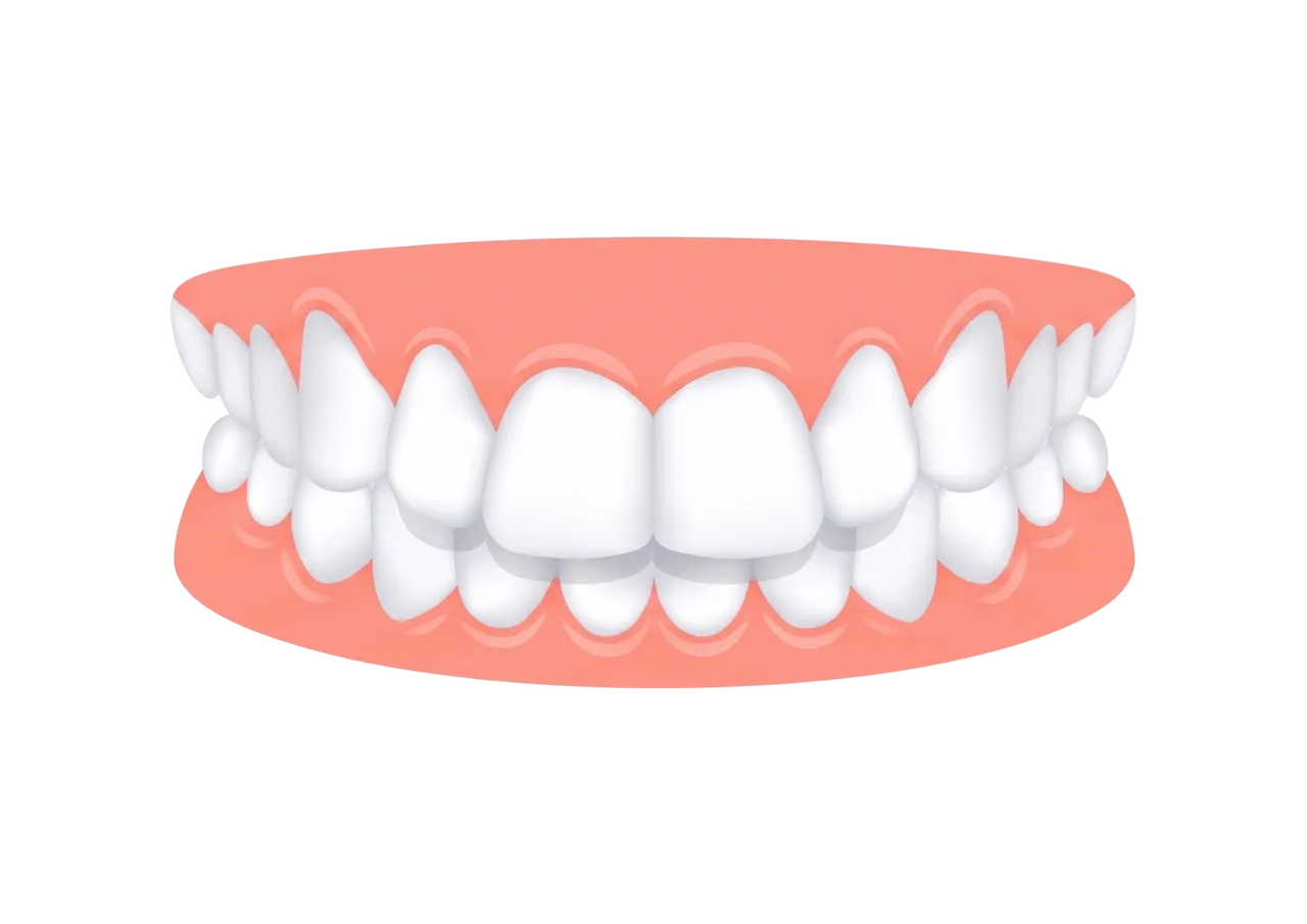 Overbite