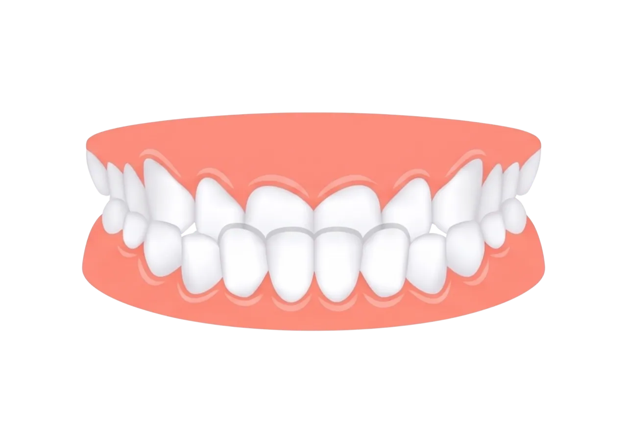 Underbite